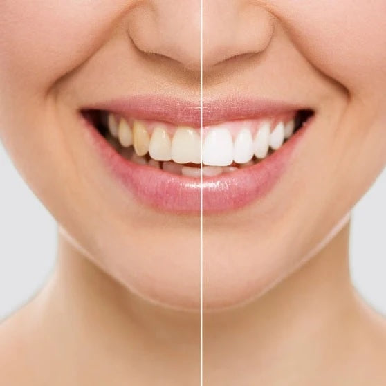 Lápis de Branqueamento Dental com Fórmula Melhora - SMILE WHITE
